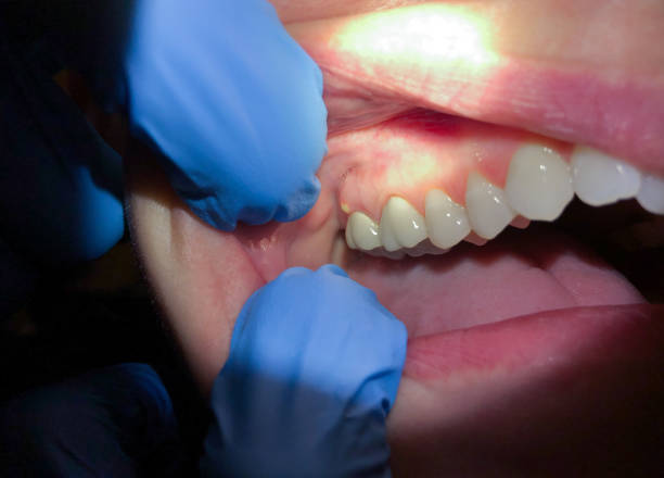 Best Emergency Treatment for Oral Infections in Batesville, MS