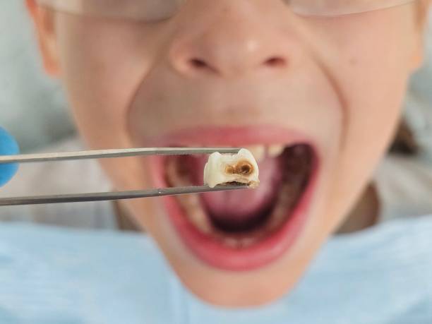 Best Broken or Chipped Tooth Repair in Batesville, MS